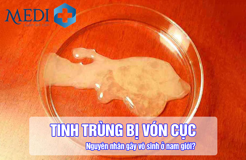Tinh trùng vón cục – Nguyên nhân và cách điều trị an toàn, hiệu quả